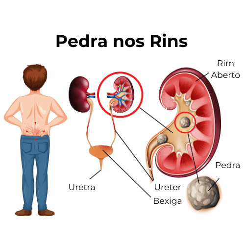 Pedra nos rins