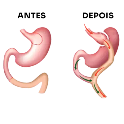 Cirurgia bariátrica tipos