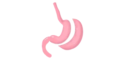 Cirurgia bariátrica tipos