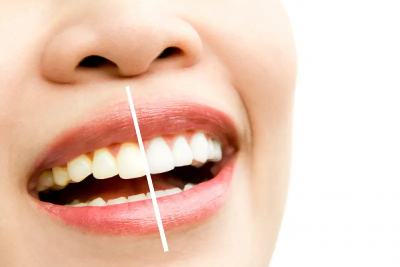 Clareamento dental ou facetas