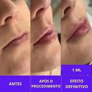 EFEITO DEFINITIVO DO PREENCHIMENTO LABIAL
