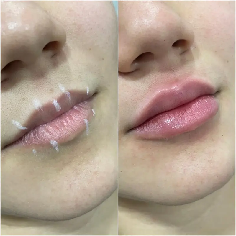 Preenchimento Labial