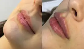 antes e depois do preenchimento labial 